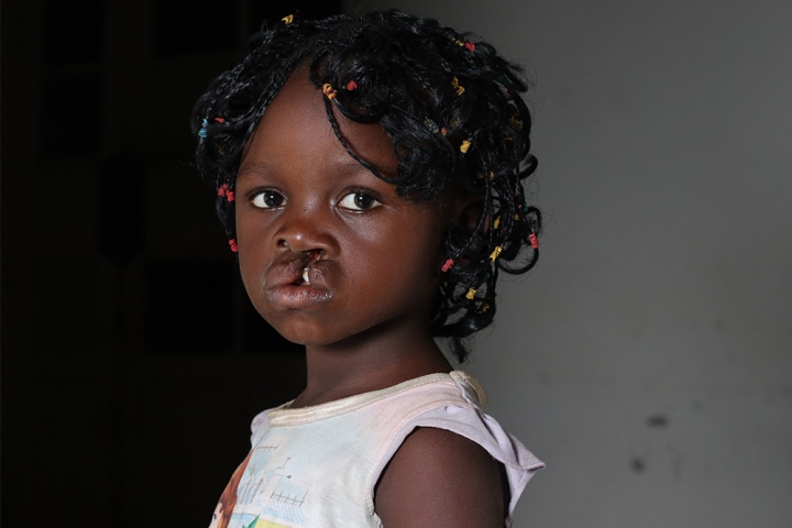Girl with cleft lip from Congo DRC
