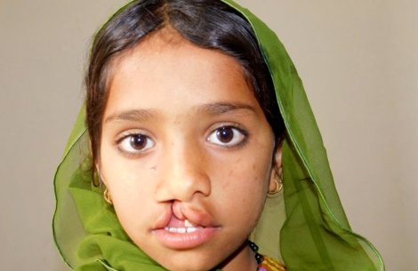 Ein junger pakistanischer Smile-Train-Patient
