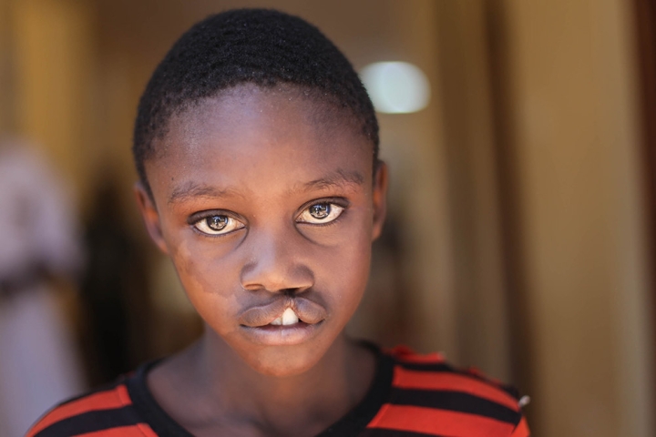 Boy untreated cleft Kenya