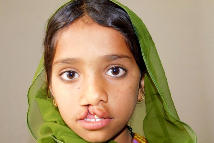 Ein junger pakistanischer Smile-Train-Patient