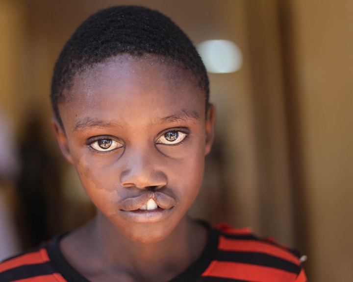 Boy untreated cleft Kenya